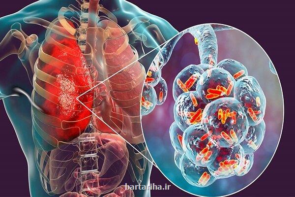 از بین بردن عفونت های ریوی مقاوم در مقابل دارو با فناوری نانو