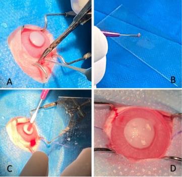 افقی تازه در درمان زخم های شدید قرنیه