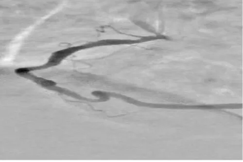 امکان افزایش دقت نمایش عروق کرونری قلب با شیوه های مبتنی بر هوش مصنوعی